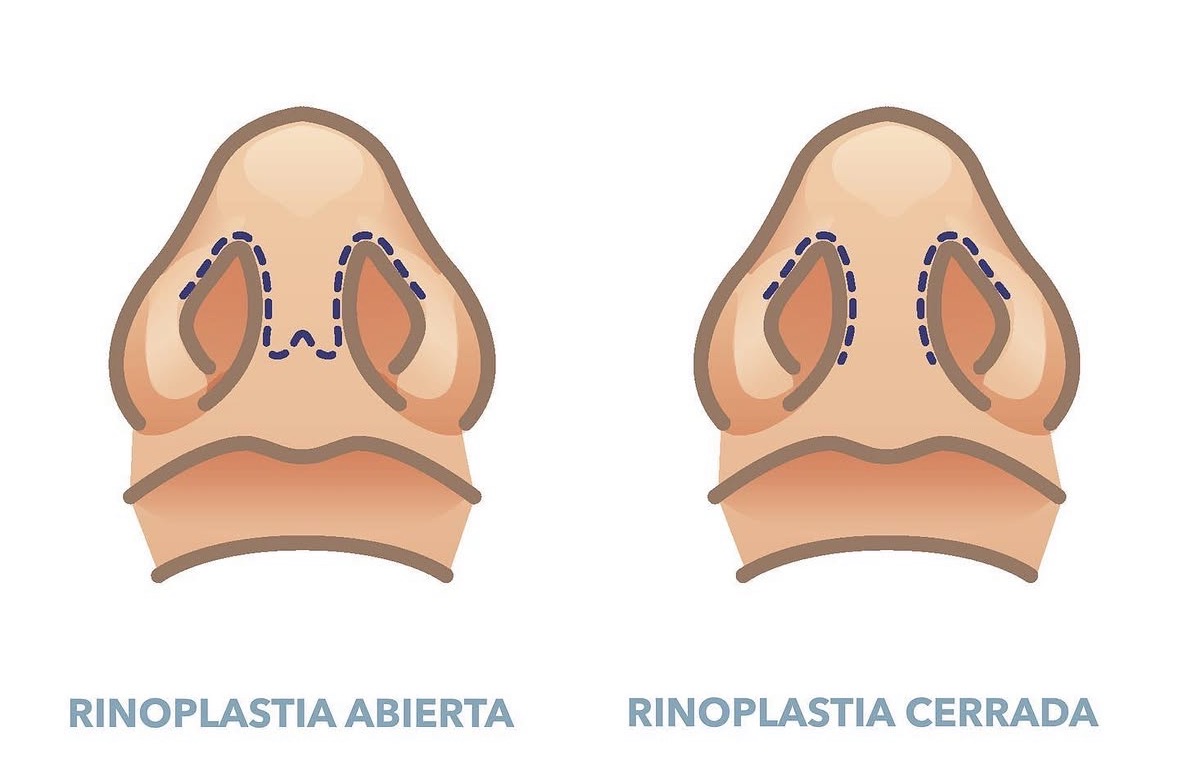 Comparación rinoplastia abierta vs cerrada - incisiones