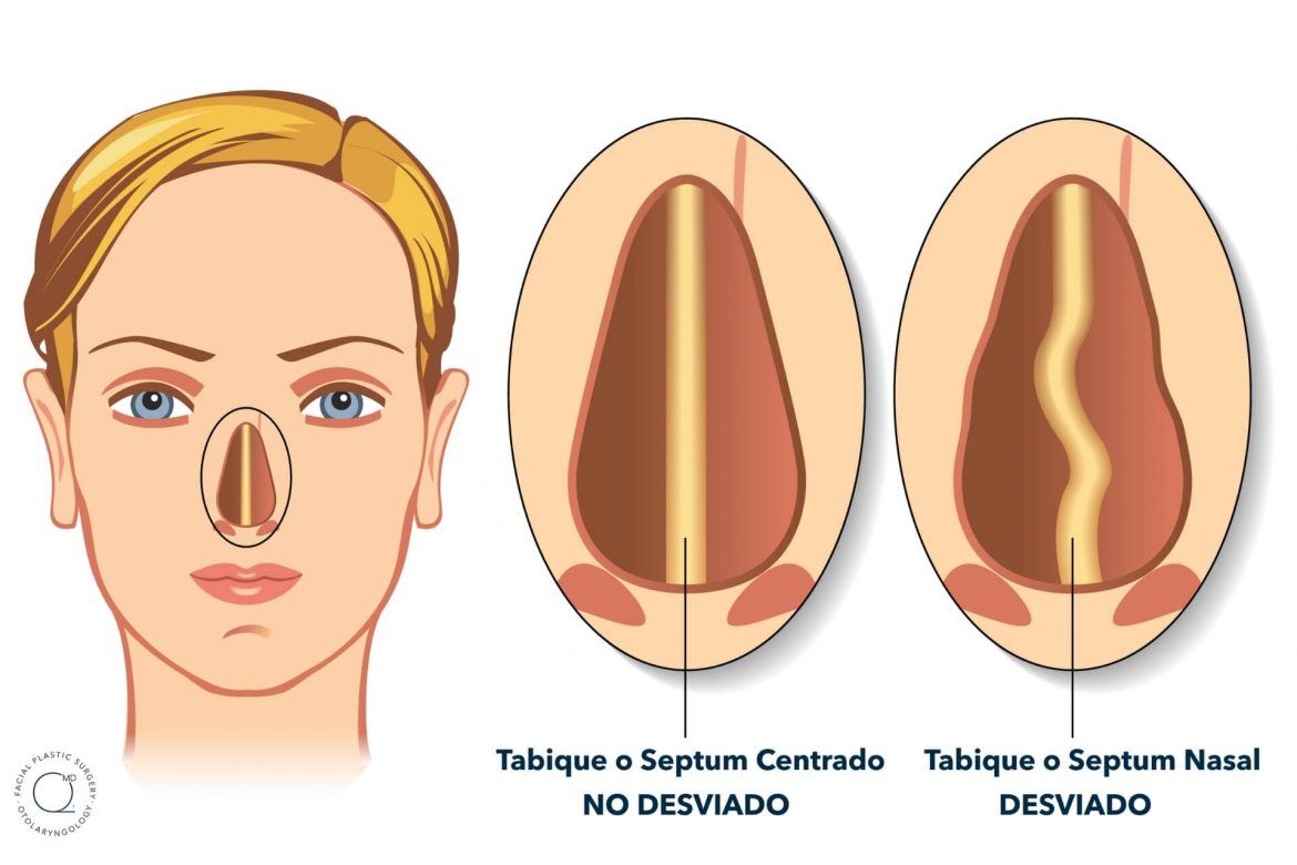 Ilustración tabique desviado y no desviado - Septorrinoplastia Dr. Jorge Duque Silva