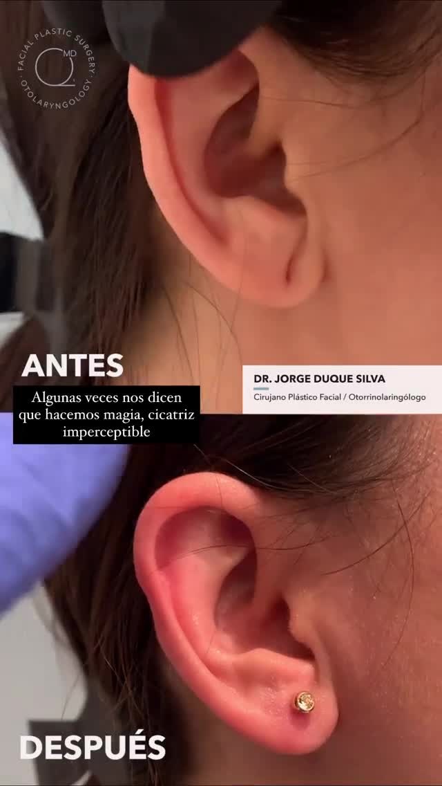 Antes y después de lobuloplastia — Dr. Jorge Duque Silva