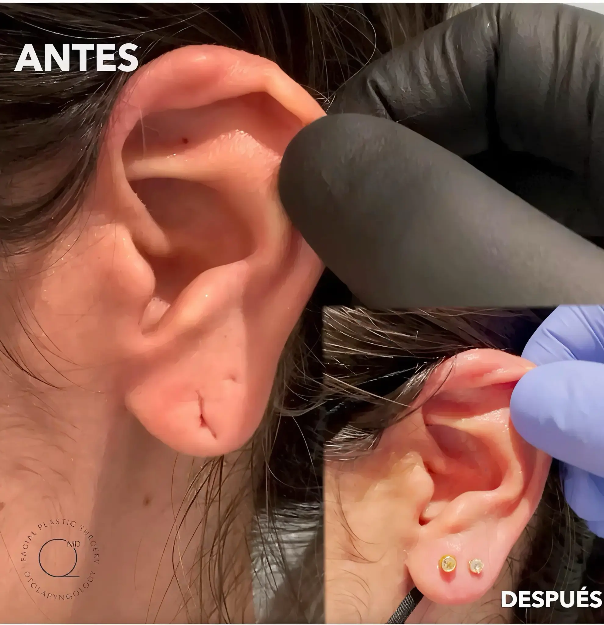 Antes y 1 mes después de lobuloplastia — Dr. Jorge Duque Silva
